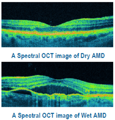 AMD Age-Related Macular Degeneration | Hesed Eye Specialists