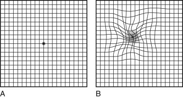 AMD Age-Related Macular Degeneration | Hesed Eye Specialists