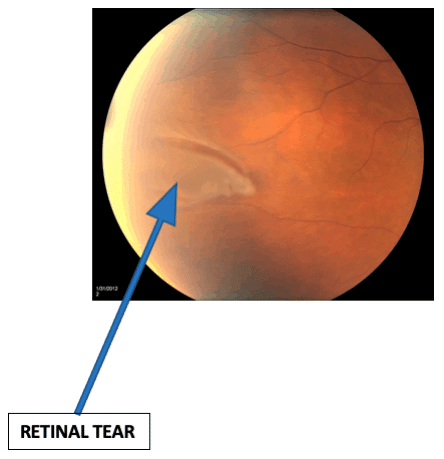 Understanding Retinal Tears