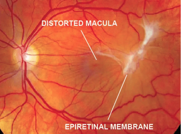 What Is an Epiretinal Membrane?