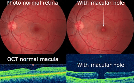 Understanding Macular Holes