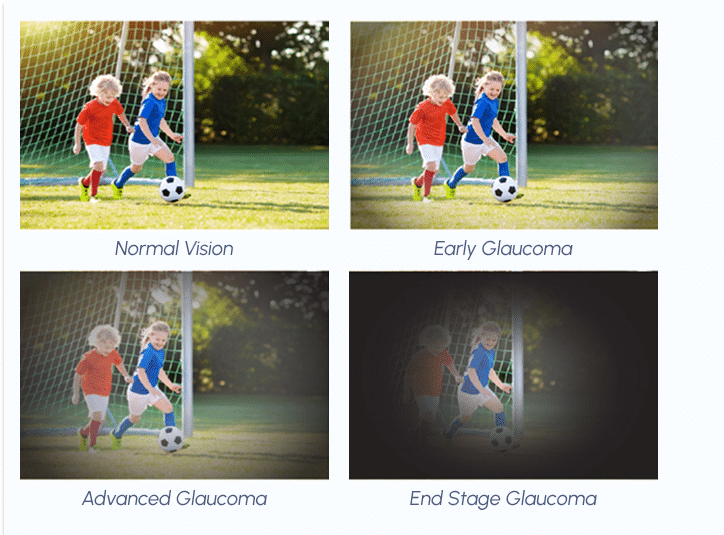 Introduction To Glaucoma