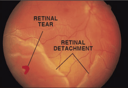 Symptoms of Retinal Detachment