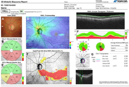 triton-optical-coherence-tomography-reports