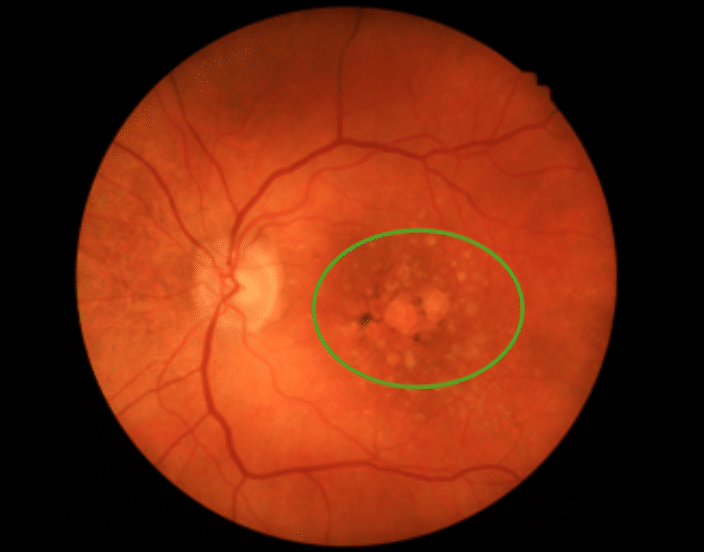 Age Related Macular Degeneration