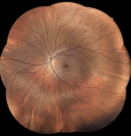 Retinal Detachment/ Floaters