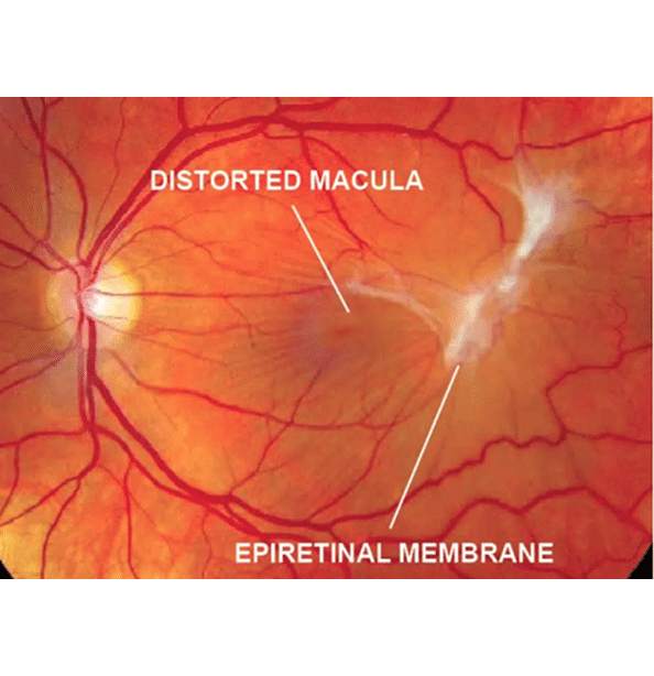 What Is an Epiretinal Membrane?