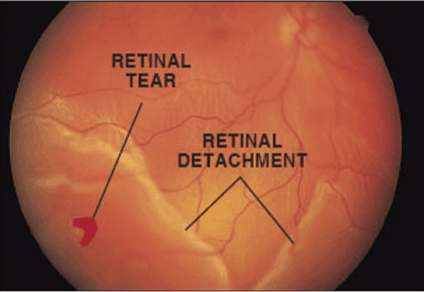Symptoms of Retinal Detachment